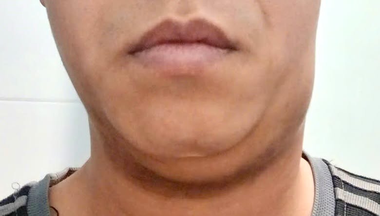 CẢNH BÁO: VIÊM TUYẾN NƯỚC BỌT VÀ NHỮNG DẤU HIỆU  KHÔNG THỂ BỎ QUA