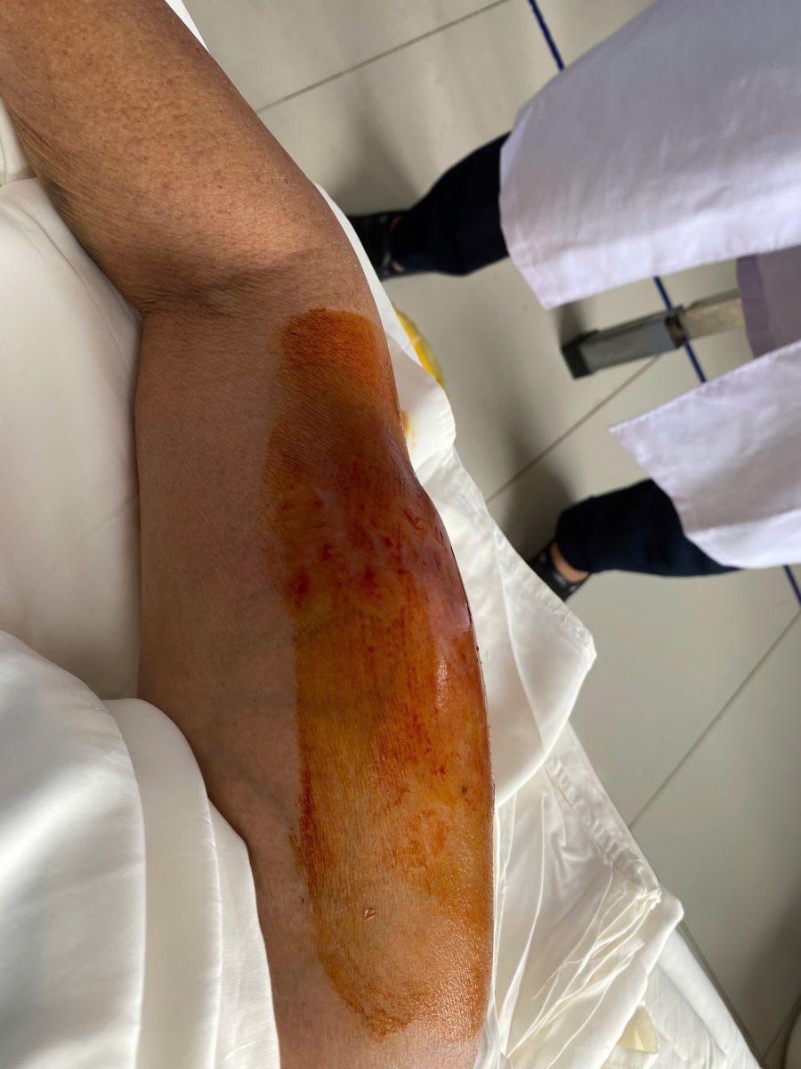 CẢNH BÁO: BIẾN CHỨNG NGUY HIỂM TỪ VIỆC TỰ Ý TIÊM TRUYỀN TẠI NHÀ