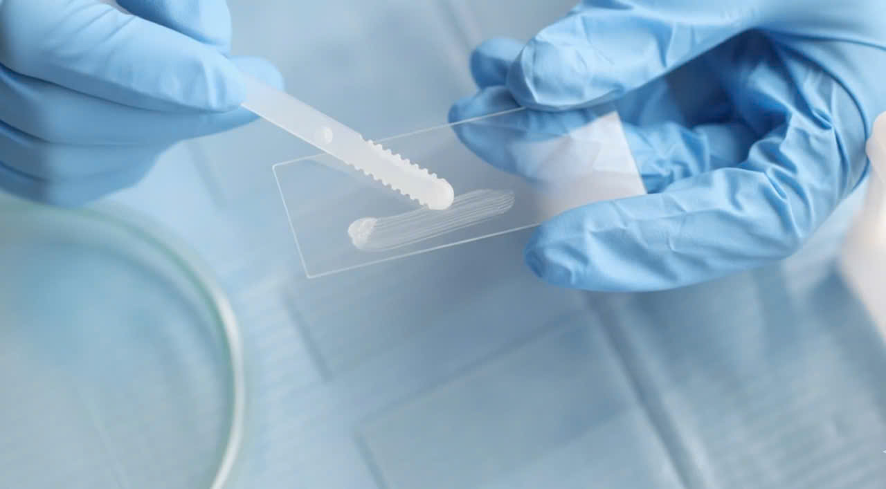 XÉT NGHIỆM PAPANICOLAOU (PAP SMEAR): GIẢI PHÁP TỐI ƯU TRONG TẦM SOÁT VÀ PHÁT HIỆN SỚM UNG THƯ CỔ TỬ CUNG