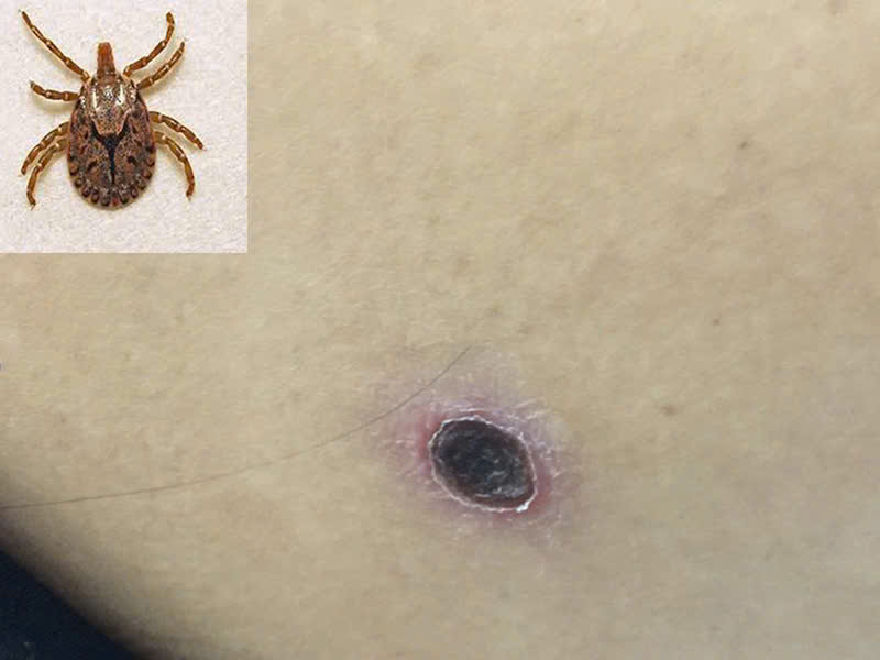 SỐT MÒ (SCRUB TYPHUS): KẺ SÁT NHÂN THẦM LẶNG TỪ BỤI RẬM – CÓ THỂ CHỮA KHỎI NẾU PHÁT HIỆN SỚM
