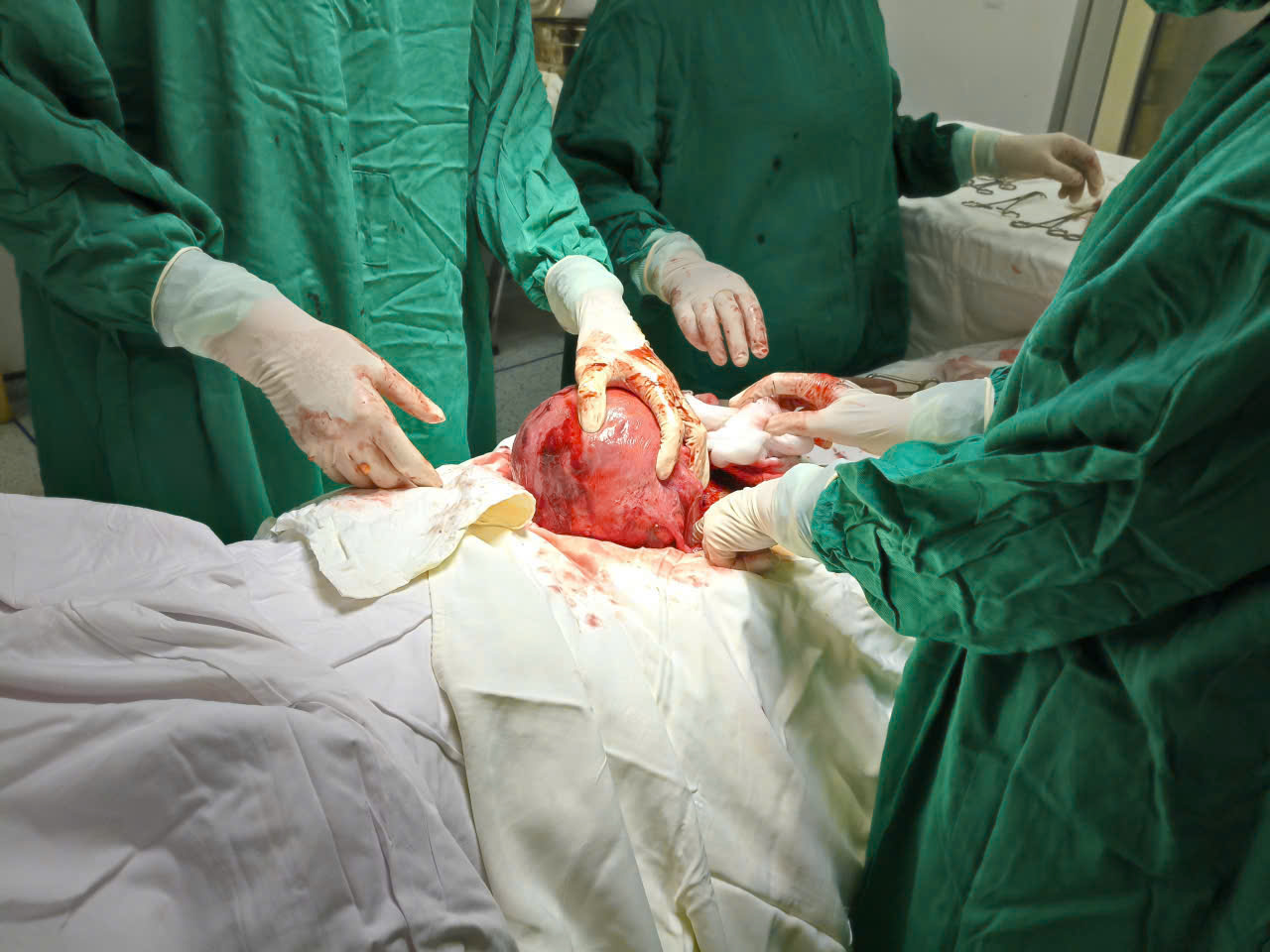 PHẪU THUẬT THÀNH CÔNG CA MỔ LẤY THAI KẾT HỢP CẮT U XƠ TỬ CUNG KÍCH THƯỚC LỚN TẠI BỆNH VIỆN ĐA KHOA TÂN YÊN