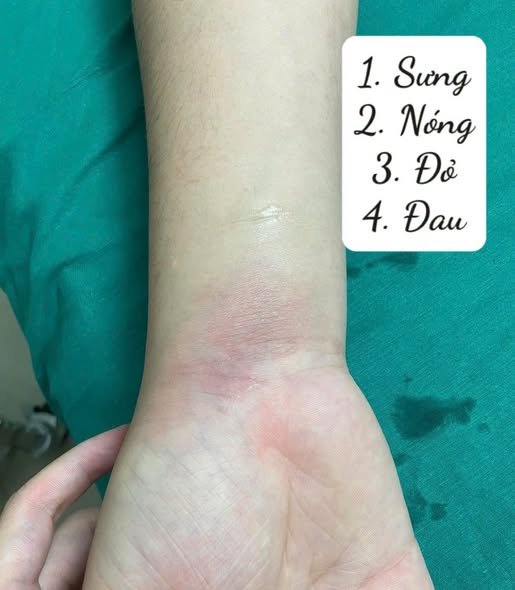 GÓC NHÌN Y KHOA: KHI BỆNH GÚT "NGỤY TRANG" DƯỚI VỎ BỌC VIÊM GÂN