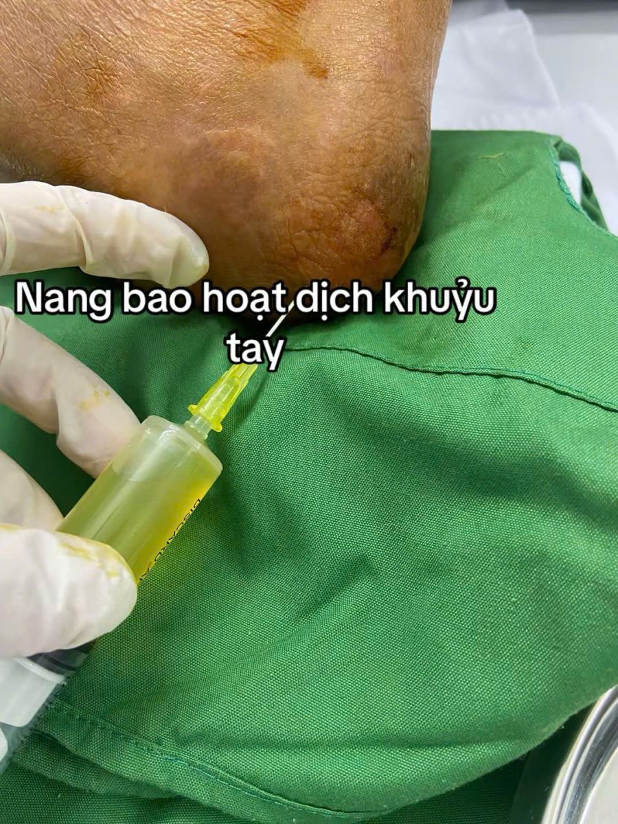 THOÁI HÓA KHỚP: “ĐỪNG ĐỢI ĐAU NẶNG MỚI ĐIỀU TRỊ!”
