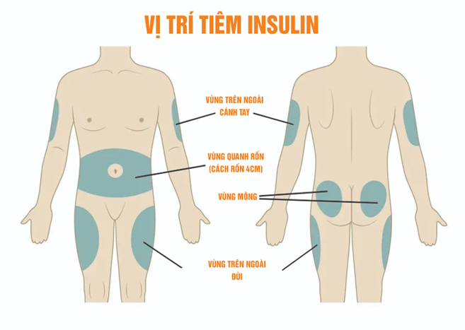 CẨM NANG Y KHOA: HƯỚNG DẪN TỰ TIÊM INSULIN TẠI NHÀ ĐẠT CHUẨN KỸ THUẬT VÀ AN TOÀN