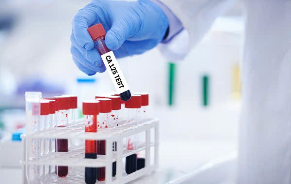 XÉT NGHIỆM CA-125: HIỂU ĐÚNG VỀ DẤU ẤN  SINH HỌC TRONG BỆNH LÝ BUỒNG TRỨNG